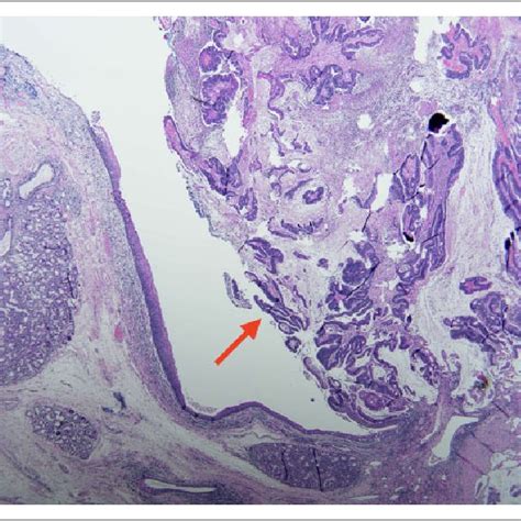 Image Of The Fungating Mass On The Right Palatine Tonsil Download