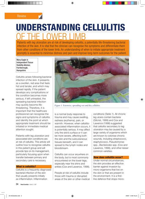 Cellulitis Treatment