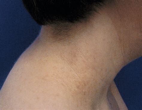 Brown Macules Symmetrically Distributed On The Neck Axillae And