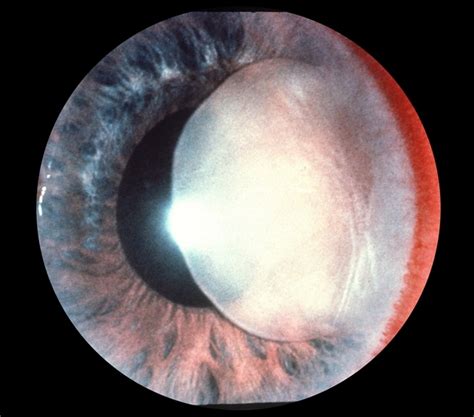 Traumatic Lens Dislocation Retina Image Bank