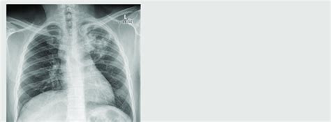 Chest X Ray Showing Patchy Consolidation Involving The Left Upper Lobe