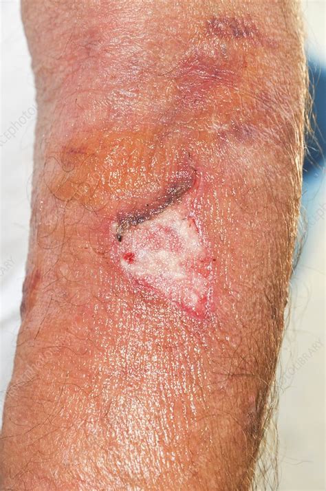 Infected Wound Stock Image C0234921 Science Photo Library