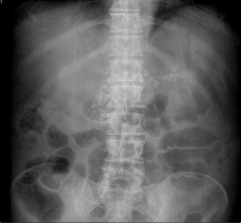 Part 2 Pancreas And Spleen Radiology Key