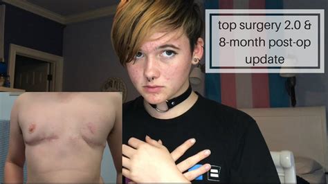 Im Getting A Top Surgery Revision Youtube