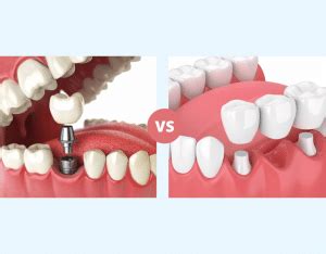 Dental Implants Vs Bridges Finding Whats Best For You