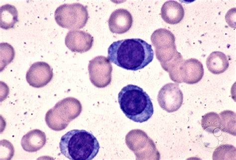 Plasma Cell Leukemia 1