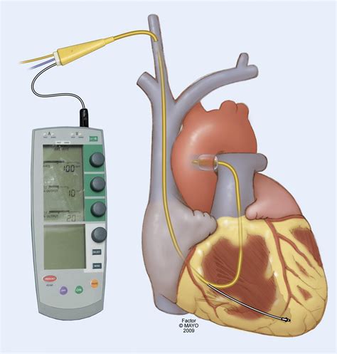 A Novel Approach Using Pulmonary Artery Catheter Directed Rapid Right