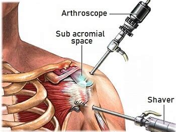 The supraspinatus is assessed by having the patient resist downward pressure on the arms held in flexion (forward) the neer test is done to check for impingement of the rotator cuff tendons under the coracoacromial arch. Supraspinatus Tendonitis: Causes, Symptoms & Treatment