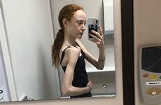 anorexia anorexic underweight severely thescottishsun