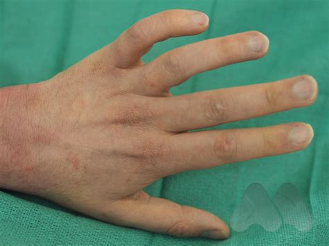 Cubital Tunnel Syndrome Claw Hand