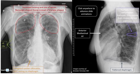 Chronic Obstructive Pulmonary Disease COPD TeachIM