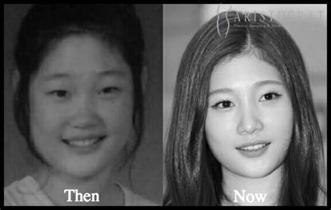 17 Us And Korean Superstars Whove Had Plastic Surgery Young Only To