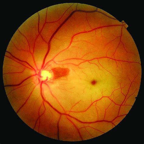 Crvo Re Showing Flame Shaped Hemorrhages In All Quadrants Giving A