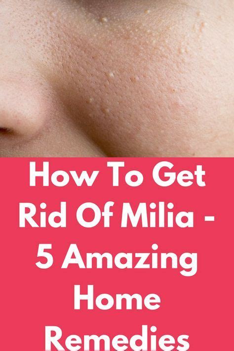 How To Get Rid Of Milia 5 Amazing Home Remedies Milia Is The Keratin