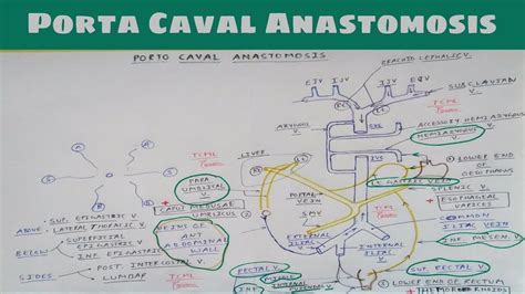Porta Caval Anastomosis Part 1 Esophageal Varices Piles The