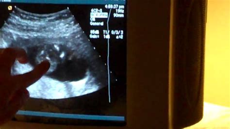 15 Week Baby Ultrasound Its A Girl Youtube