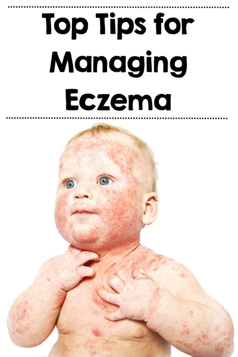 This Week Is Nationaleczemaweek And The National Eczema Society Are