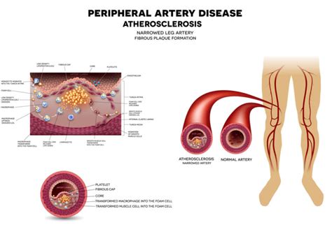 Peripheral Vascular Disease Optimum Health