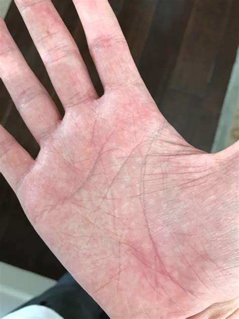 Why Does My Hand On Occasion Look Like It Has Red And White Spots On