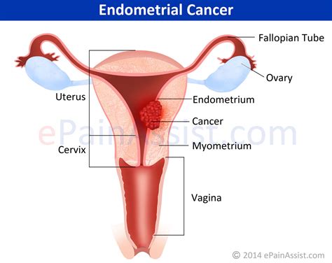 Artificial womb technology (awt) substitutes for a real womb right from the start so the foetus never needs to be inside a human and works as if the baby is the law in the uk, and 11 other countries, bans human embryos developing outside the body for more than 14 days. Endometrial Cancer or Uterine Cancer|Symptoms|Treatment ...