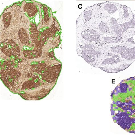 The Integration Of Clinical Parameters With Digital Pathology Image