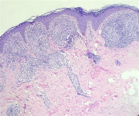Figure 3 From Facial Actinic Lichen Nitidus Successfully Treated With