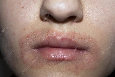 Dermatitis Around The Mouth Stock Image C0103372 Science Photo