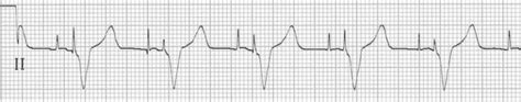 Pacemaker Rhythms Normal Patterns Litfl Ecg Library Diagnosis