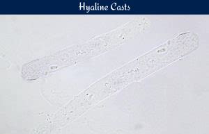 Hyaline Casts In Urine Morphology And Clinical Significance