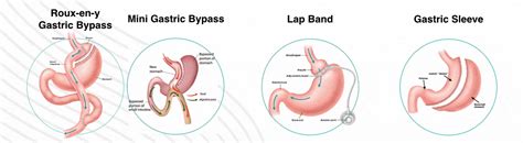 Bariatric Surgery In Melbourne Centre For Weight Loss