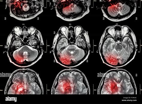 film l imagerie par résonance magnétique irm du cerveau irm de cerveau est le cerveau