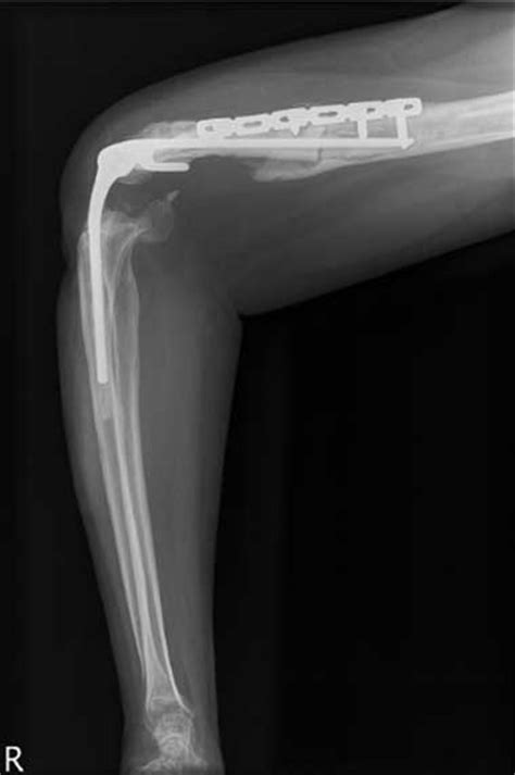 Sideswipe Injuries To The Elbow In Western Australia The Medical