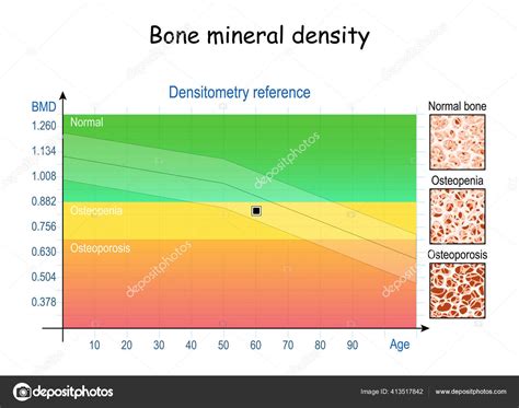 Bone Mineral Density Bmd Densitometry Reference Chart Close Condition