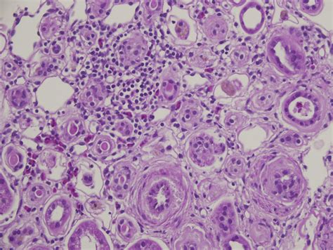 Chronic Interstitial Nephritis With Interstitial Lymphocytic Infiltrate