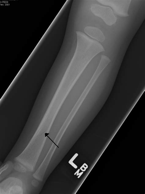Toddlers Fracture Wikem