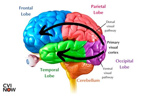 Higher Order Visual Pathways And The Cvi Brain Perkins School For The