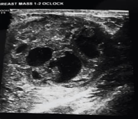 Breast Cysts With Masses Versus Breast Masses With Cysts Sonographic
