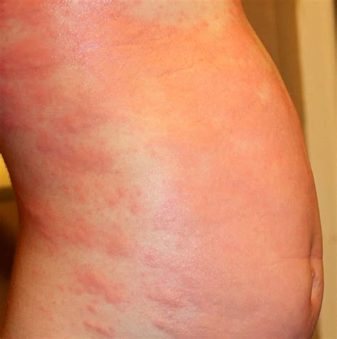 Allergic reactions vary and include many different symptoms. Hives ⋆ Homemade for Elle