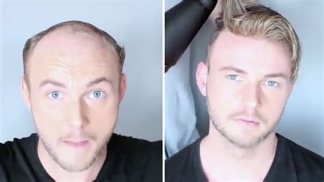 These Toupee Transformations Are Going Viral Allure