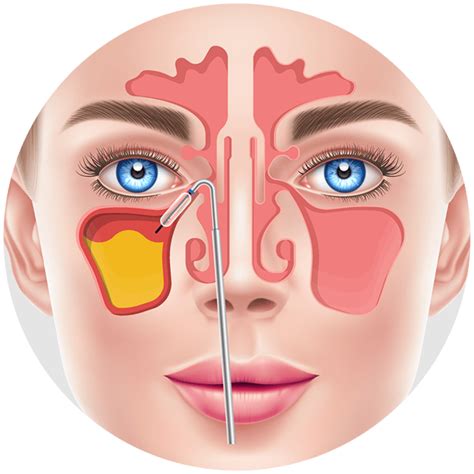 Balloon Sinuplasty Advanced Sinus Relief Centers