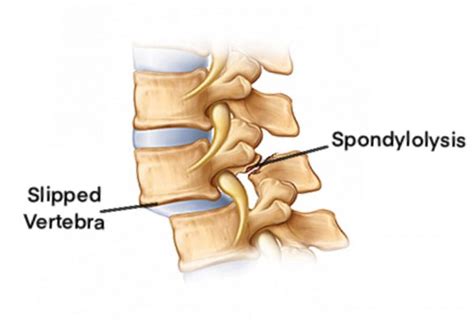 Spondylolisthesis Best Spine Surgery Treatment In Mumbai