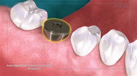Post Operative Instructions For A Single Implant With Healing Cap Complete Dental