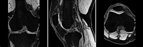 Knee Joint Fat Suppressed Mri Used For Manual Cartilage Segmentation