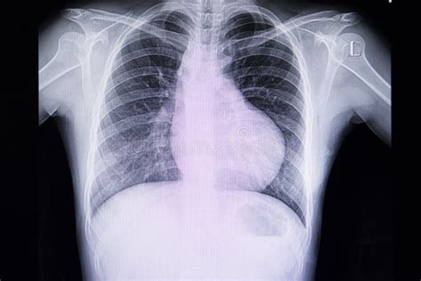 Chest Xray Film Of A Patient With Right Ventricular Hypertrophy Stock