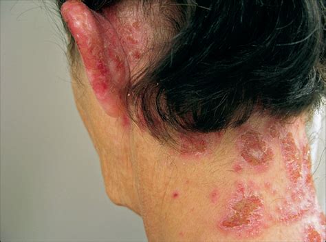 People who are allergic to hair dyes will experience redness of the ears, scalp or neck. Neutrophilic and Eosinophilic Dermatitis Caused by Contact ...