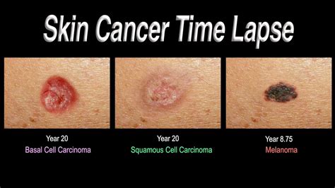 Skin Cancer Time Lapse Basal Cell Carcinoma Squamous Cell Carcinoma Melanoma YouTube