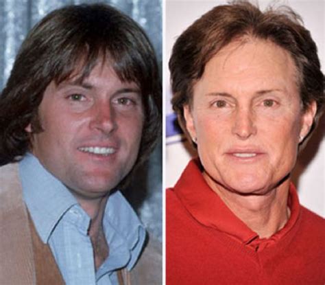 Free General Fashion Bruce Jenner Plastic Surgery Before And After
