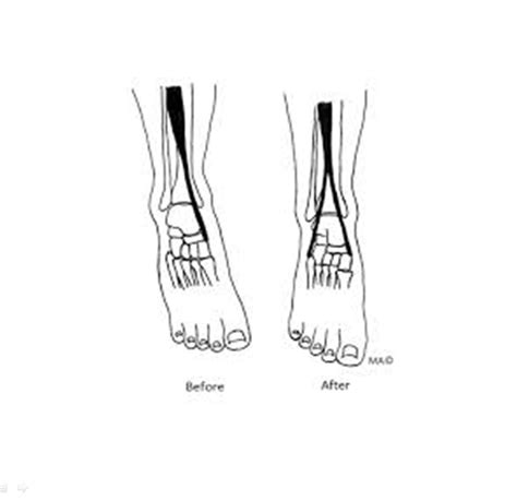 Tibialis Anterior Transfer For Relapsed Club Foot