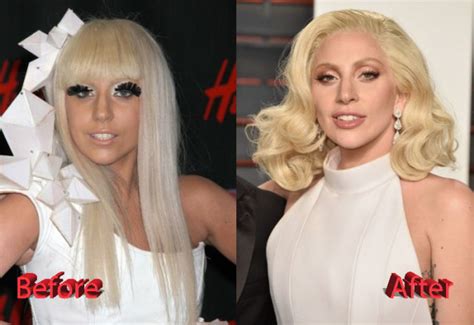 Lady Gaga Nose Job A Multiple Plastic Surgery Procedures