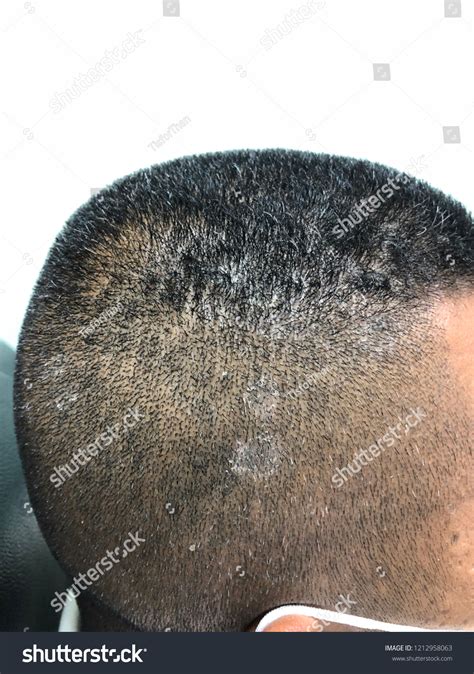 Multiple Illdefined Patch White Scale Scalp Stock Photo 1212958063